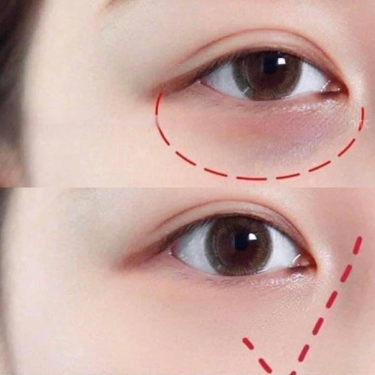 کرم دورچشم هیالورونیک تری دبلیوکلینیک
